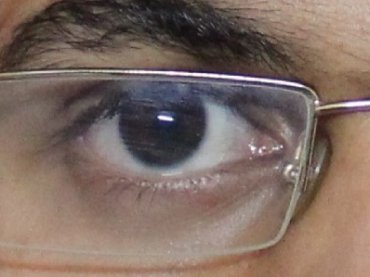 Corneal Abscess